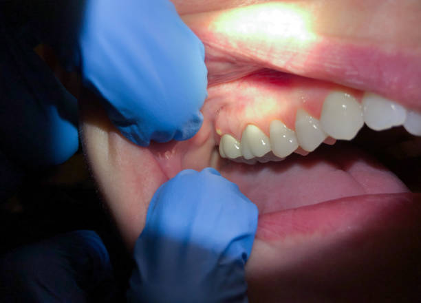 Best Emergency Tooth Extraction in Redkey, IN