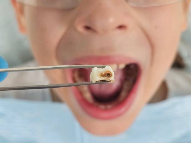 Best Emergency Dental Care for Broken or Chipped Teeth in Redkey, IN